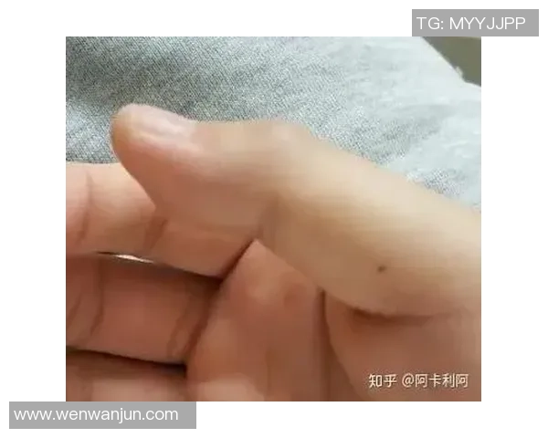 手被篮球戳了怎么办如何快速缓解疼痛并预防后续伤害